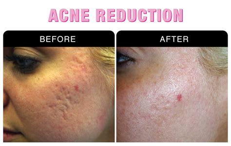 Folate and Acne Reduction